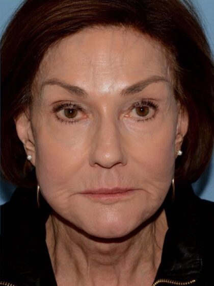 Mini Facelift Before & After Patient #5458