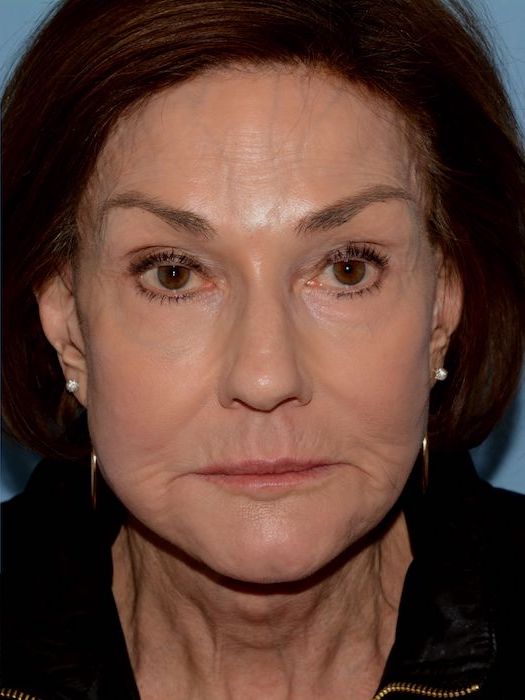 Y Lift Before & After Patient #5458