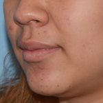 Acne Treatment Before & After Patient #5495
