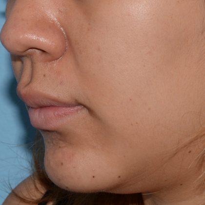 Acne Treatment Before & After Patient #5495