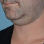 Neck Liposuction Before & After Patient #5453