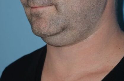 Neck Liposuction Before & After Patient #5453