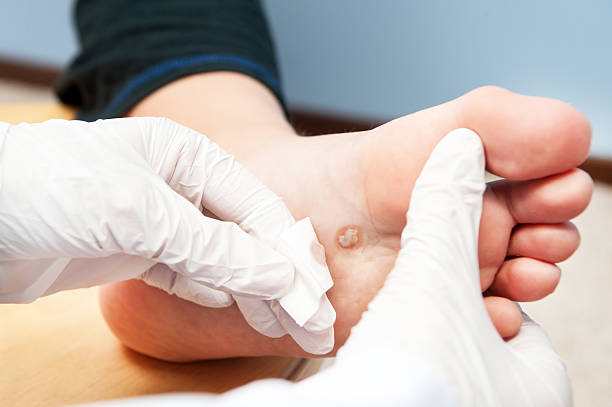 wart removal scottsdale