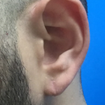 Earlobe Repair Before & After Patient #5592