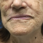 Mohs Surgery Before & After Patient #5600