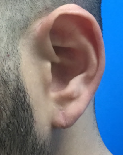 Earlobe Repair Before & After Patient #5592