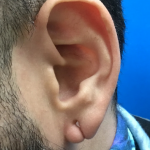 Earlobe Repair Before & After Patient #5592