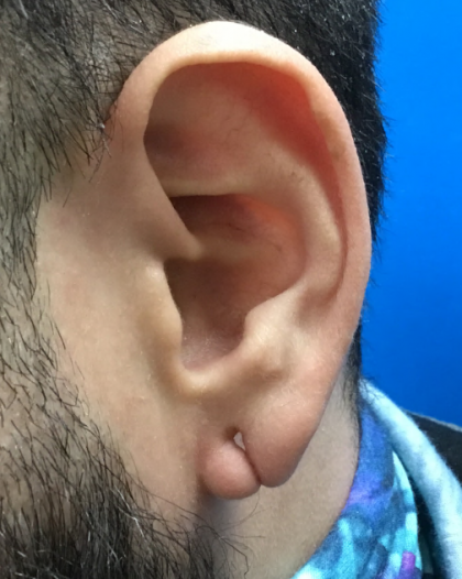 Earlobe Repair Before & After Patient #5592