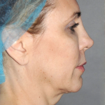 Y Lift Before & After Patient #5680
