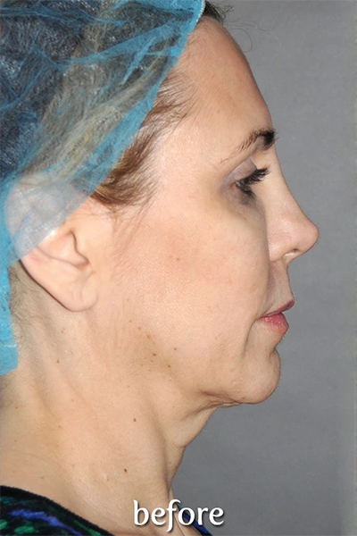 Y Lift Before & After Patient #5680