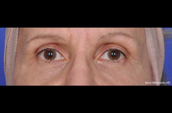 Thermi Smooth Before & After Patient #5843