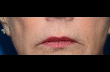 Thermi Smooth Before & After Patient #5852