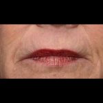 Thermi Smooth Before & After Patient #5852