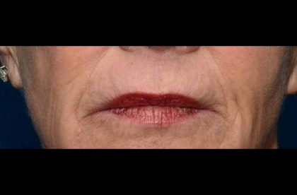 Thermi Smooth Before & After Patient #5852