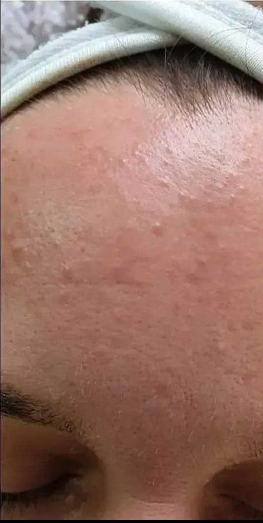 BioRePeel Before & After Patient #6227