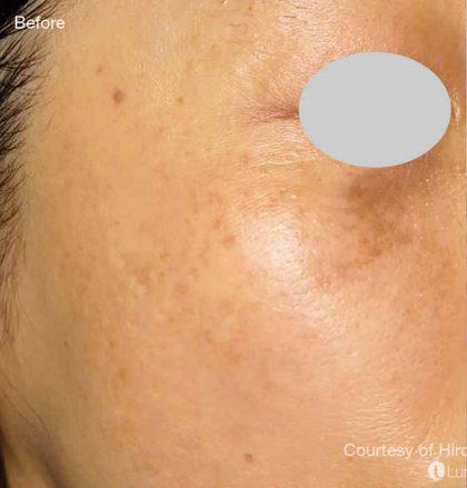 IPL For Pigmentation Before & After Patient #6177