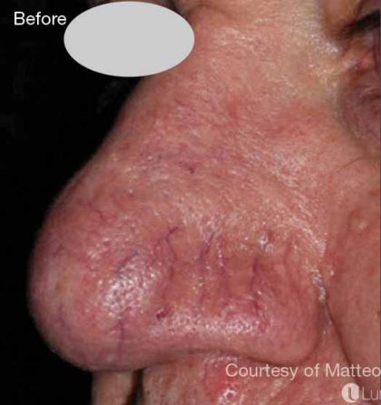 Before & After Patient #6178