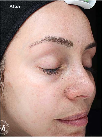 VI Peel Before & After Patient #6256