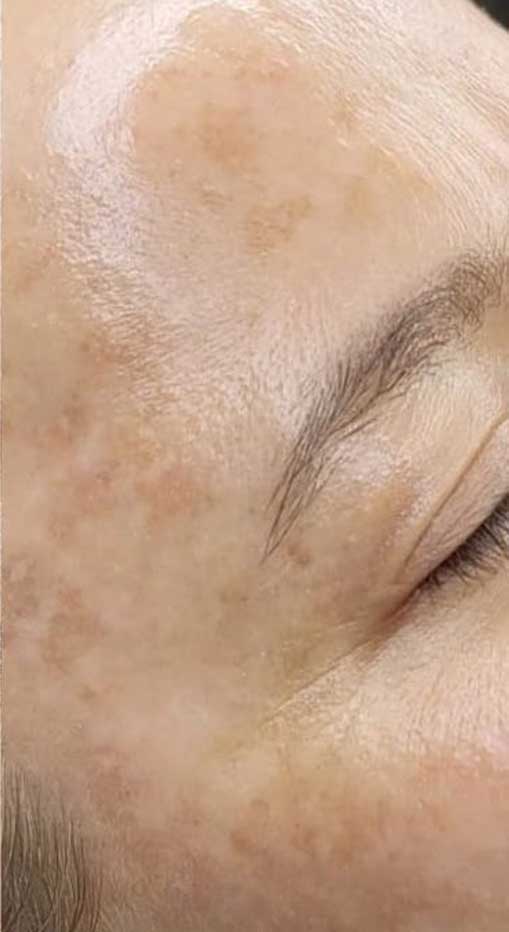 BioRePeel Before & After Patient #6232