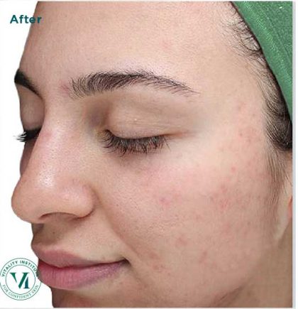 VI Peel Before & After Patient #6248