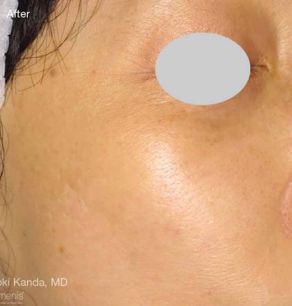 IPL For Pigmentation Before & After Patient #6177