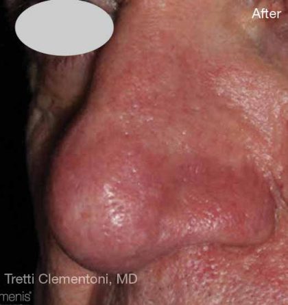 Before & After Patient #6178