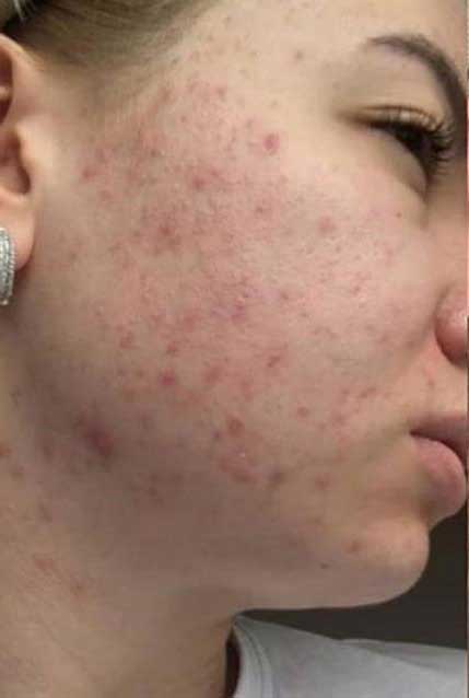 BioRePeel Before & After Patient #6228