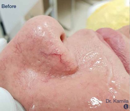 Before & After Patient #6194