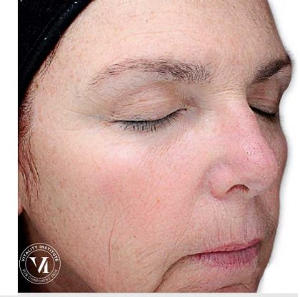 VI Peel Before & After Patient #6254