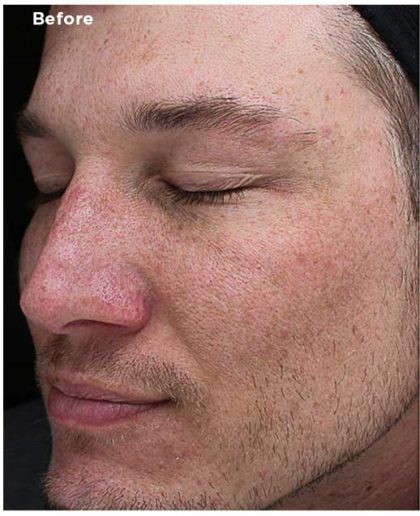 VI Peel Before & After Patient #6255