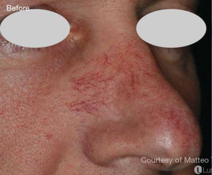 Before & After Patient #6195