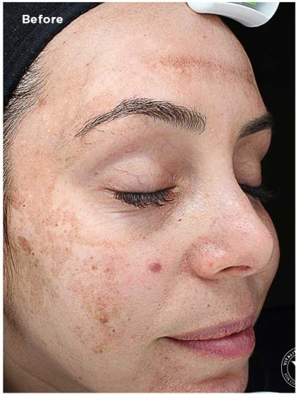 VI Peel Before & After Patient #6256