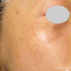 IPL For Pigmentation Before & After Patient #6177