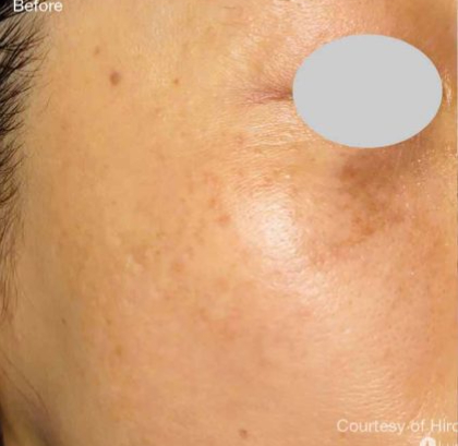 IPL For Pigmentation Before & After Patient #6177