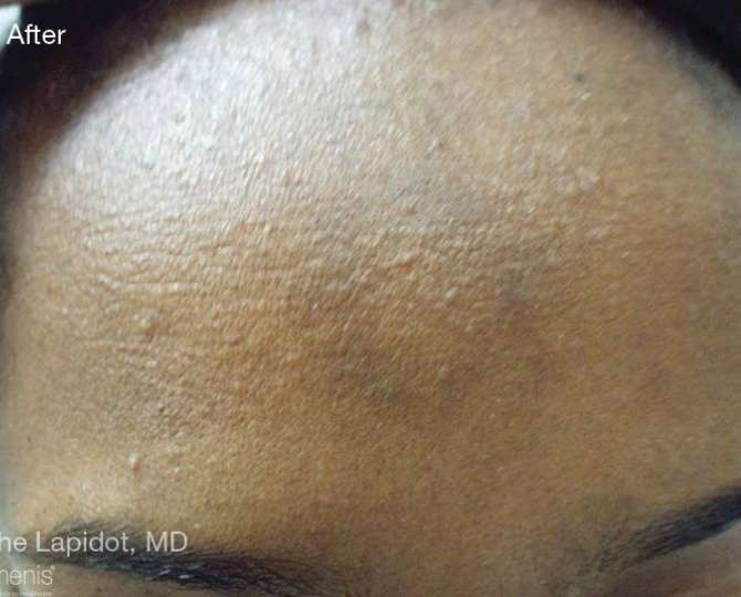 Stellar M22 Tattoo Removal Before & After Patient #6297