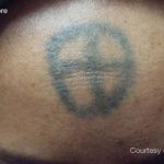 Stellar M22 Tattoo Removal Before & After Patient #6297
