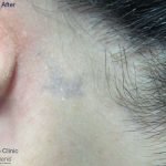 Stellar M22 Tattoo Removal Before & After Patient #6303