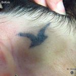 Stellar M22 Tattoo Removal Before & After Patient #6303