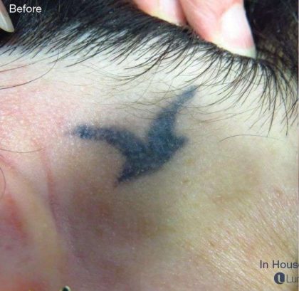 Stellar M22 Tattoo Removal Before & After Patient #6303