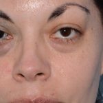 PicoSure Focus Before & After Patient #6406