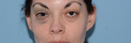 PicoSure Focus Before & After Patient #6406