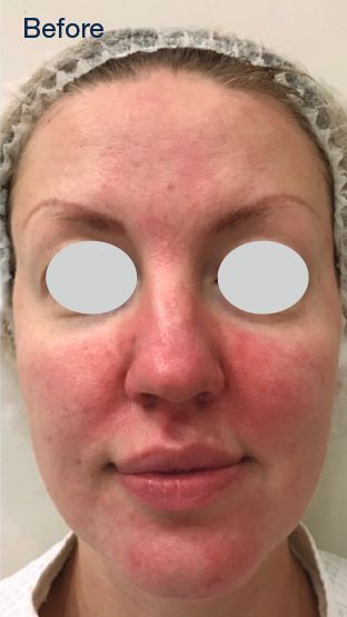 IPL Rosacea Before & After Patient #6485