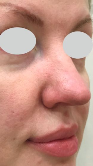 IPL Rosacea Before & After Patient #6485