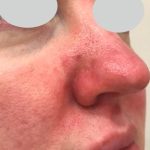 IPL Rosacea Before & After Patient #6485