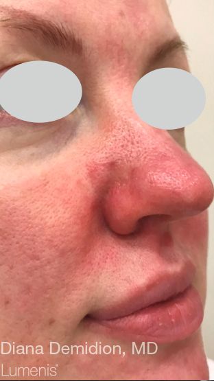 IPL Rosacea Before & After Patient #6485