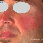 IPL Rosacea Before & After Patient #6490