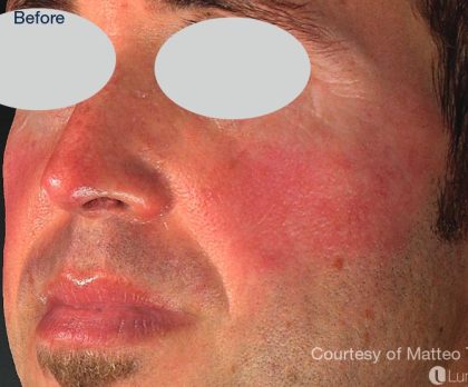 IPL Rosacea Before & After Patient #6490