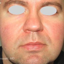 IPL Rosacea Before & After Patient #6493