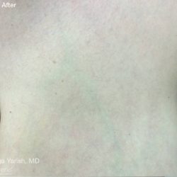 ResurFX Before & After Patient #6527