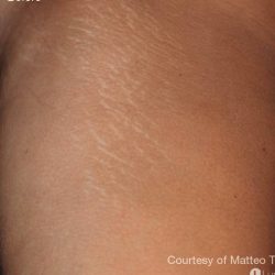 ResurFX Before & After Patient #6528